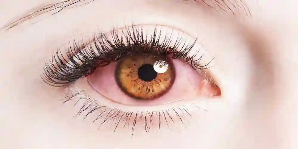 Red and Bloodshot Eyes: