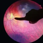 diabetic retinopathy