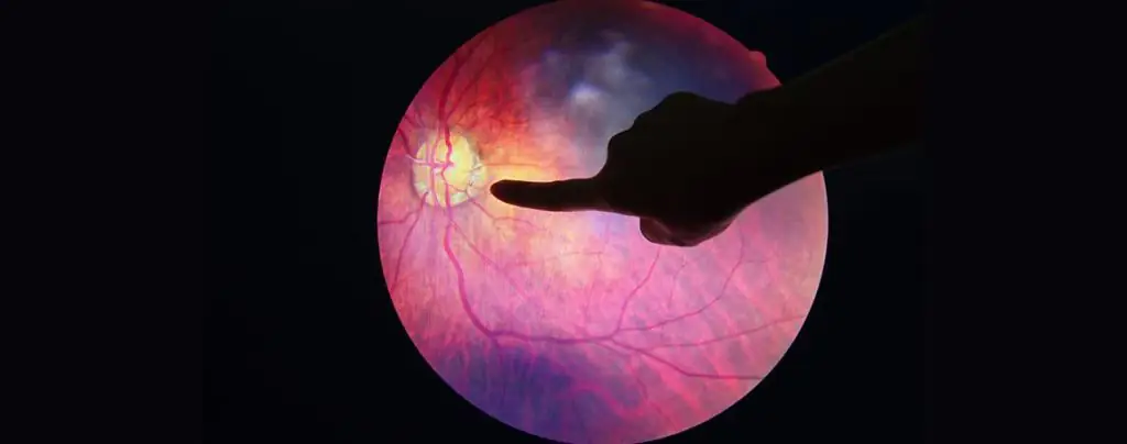 diabetic retinopathy