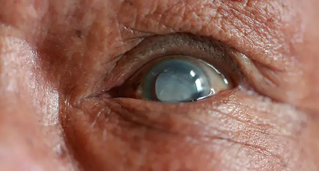 Cataract Surgery