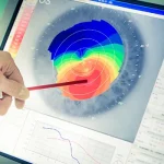 What to Expect Before and After Corneal Transplant Surgery