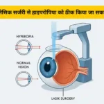 क्या लेसिक सर्जरी से हाइपरोपिया को ठीक किया जा सकता है
